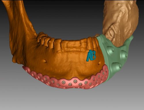 Patient Specific Implants (PSi)