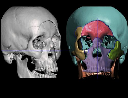 In-house 3D Virtual Planning in Maxillofacial surgery