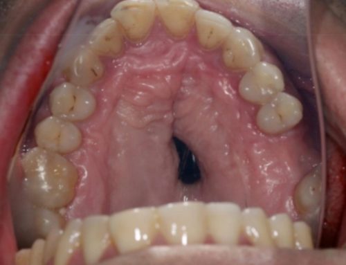 Cocaine related oronasal fistula (hole) real life case