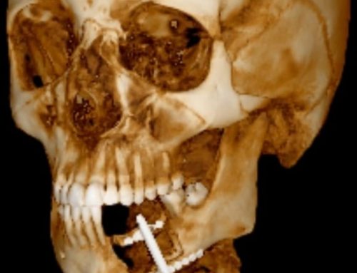 Distraction osteogenesis for the reconstruction of deficient alveolar bone